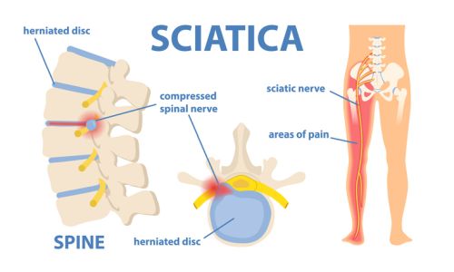 Sleeping with Sciatica, Spinal Stenosis and Herniated Discs - Contour Living